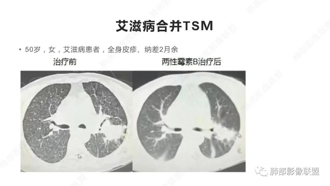 影像PPT - 【PPT】马尔尼菲篮状菌的CT表现-10 影像PPT - 【PPT】马尔尼菲篮状菌的CT表现-10