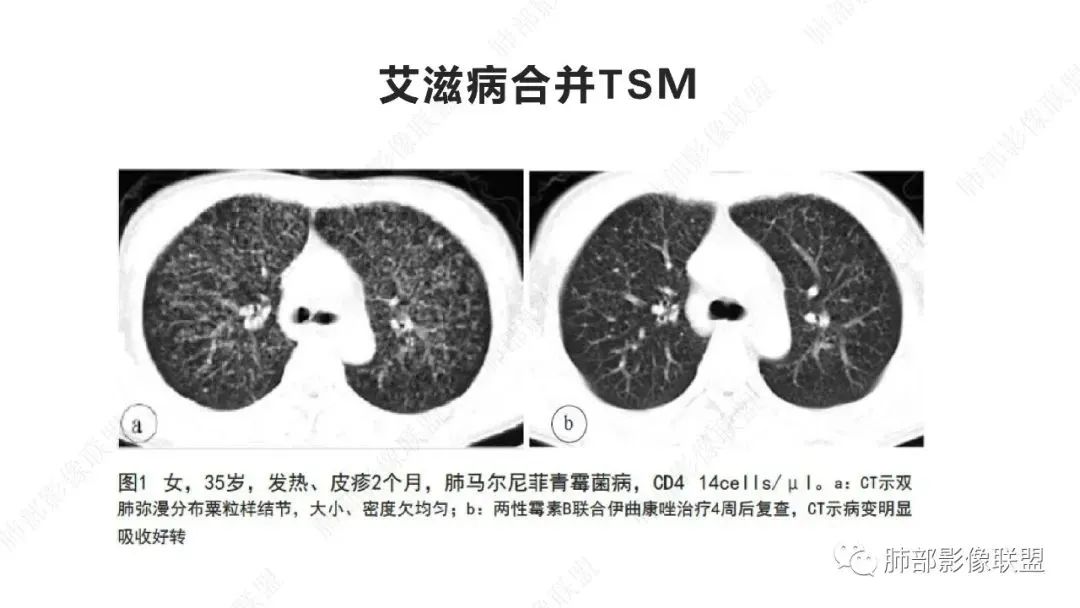 影像PPT - 【PPT】马尔尼菲篮状菌的CT表现-11 影像PPT - 【PPT】马尔尼菲篮状菌的CT表现-11