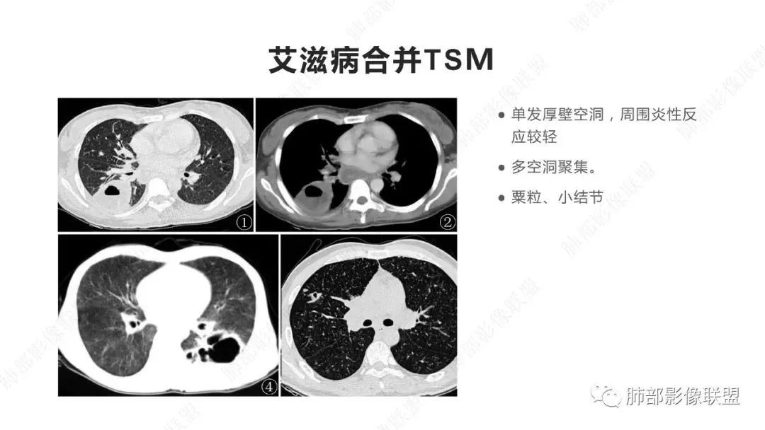 影像PPT - 【PPT】马尔尼菲篮状菌的CT表现-12 影像PPT - 【PPT】马尔尼菲篮状菌的CT表现-12