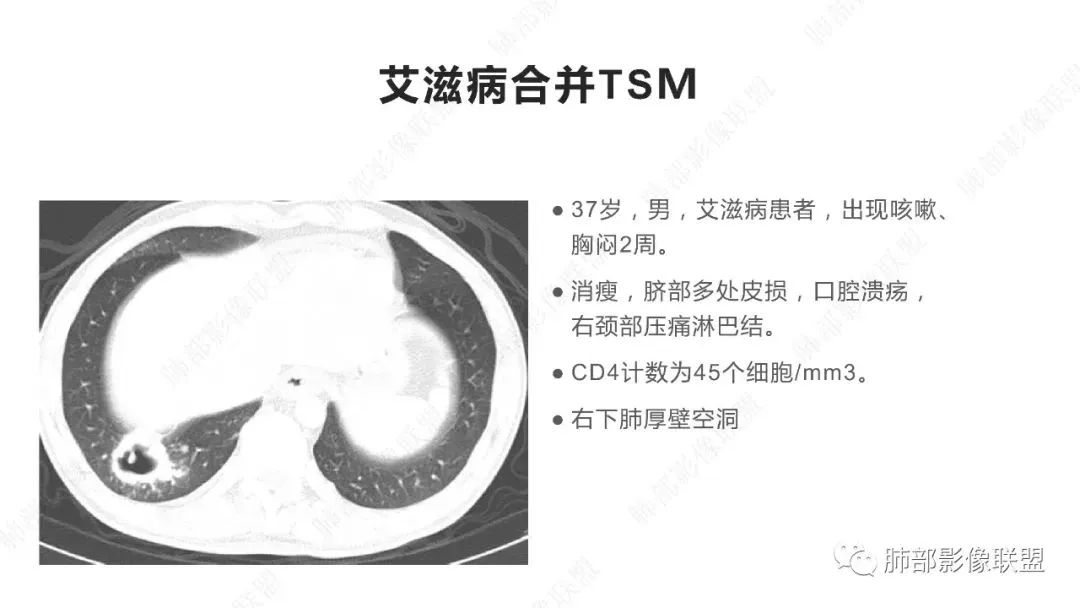 影像PPT - 【PPT】马尔尼菲篮状菌的CT表现-13 影像PPT - 【PPT】马尔尼菲篮状菌的CT表现-13