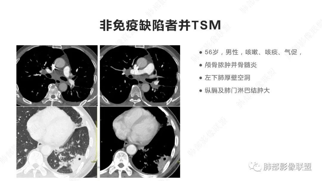 影像PPT - 【PPT】马尔尼菲篮状菌的CT表现-14 影像PPT - 【PPT】马尔尼菲篮状菌的CT表现-14