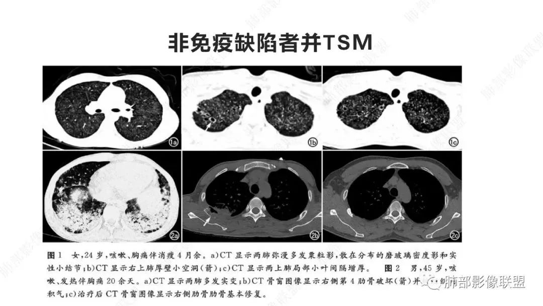 影像PPT - 【PPT】马尔尼菲篮状菌的CT表现-15 影像PPT - 【PPT】马尔尼菲篮状菌的CT表现-15