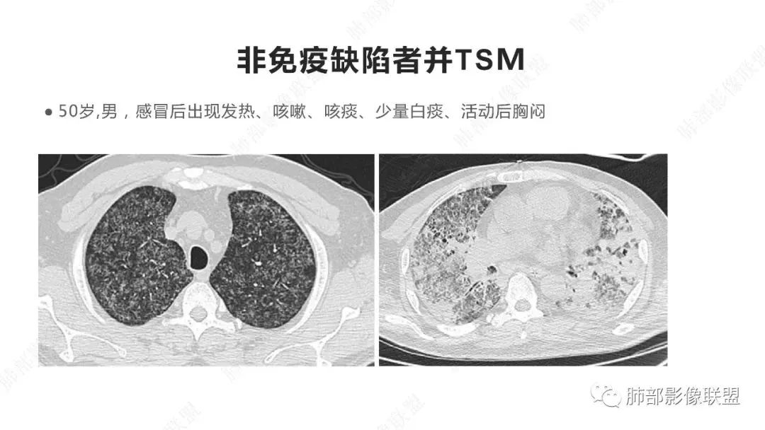 影像PPT - 【PPT】马尔尼菲篮状菌的CT表现-16 影像PPT - 【PPT】马尔尼菲篮状菌的CT表现-16