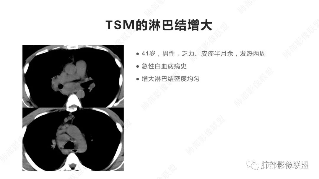 影像PPT - 【PPT】马尔尼菲篮状菌的CT表现-18 影像PPT - 【PPT】马尔尼菲篮状菌的CT表现-18