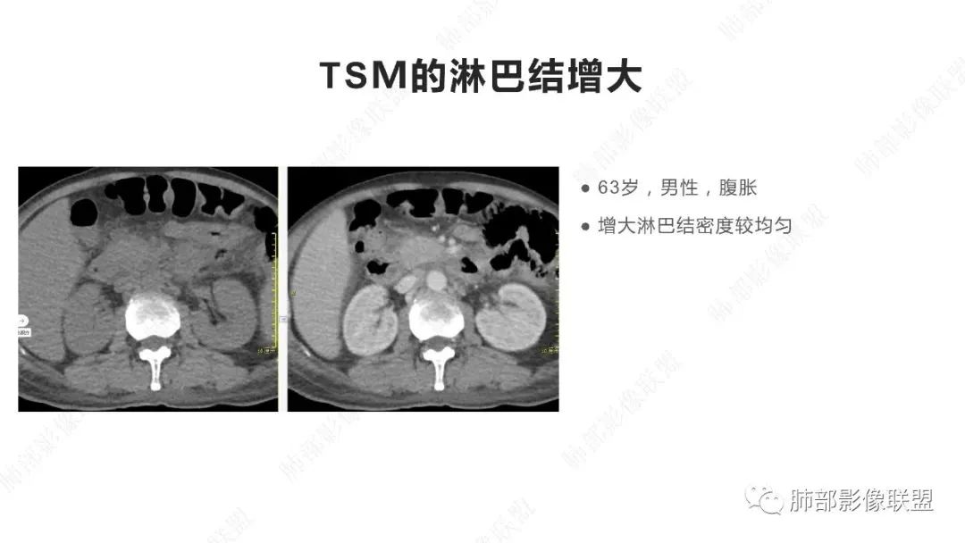 影像PPT - 【PPT】马尔尼菲篮状菌的CT表现-19 影像PPT - 【PPT】马尔尼菲篮状菌的CT表现-19