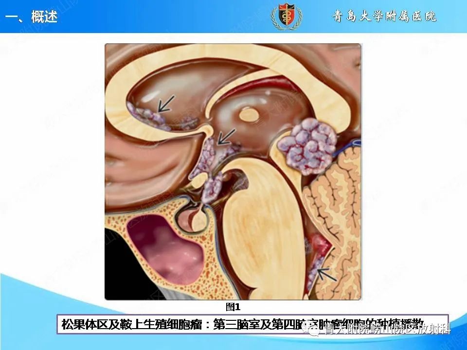 影像PPT - 【PPT】颅内生殖细胞瘤的影像学诊断-8