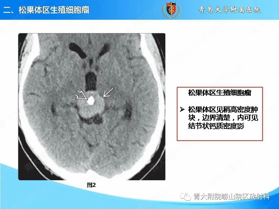 影像PPT - 【PPT】颅内生殖细胞瘤的影像学诊断-10