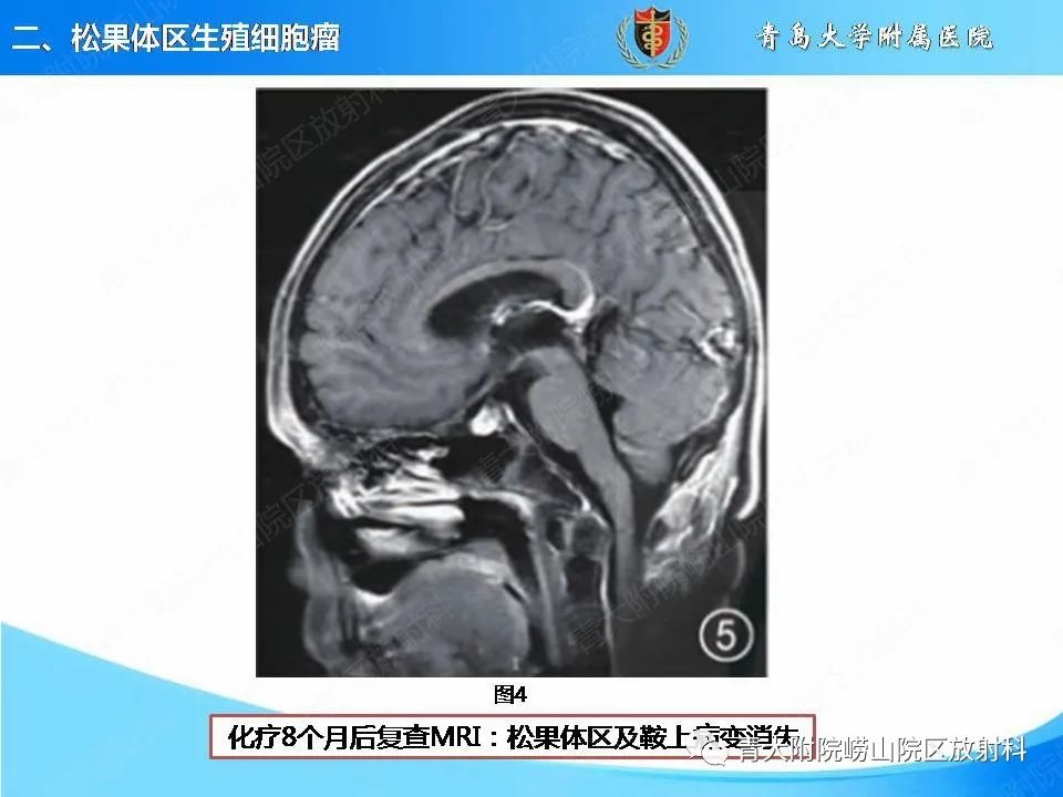 影像PPT - 【PPT】颅内生殖细胞瘤的影像学诊断-12