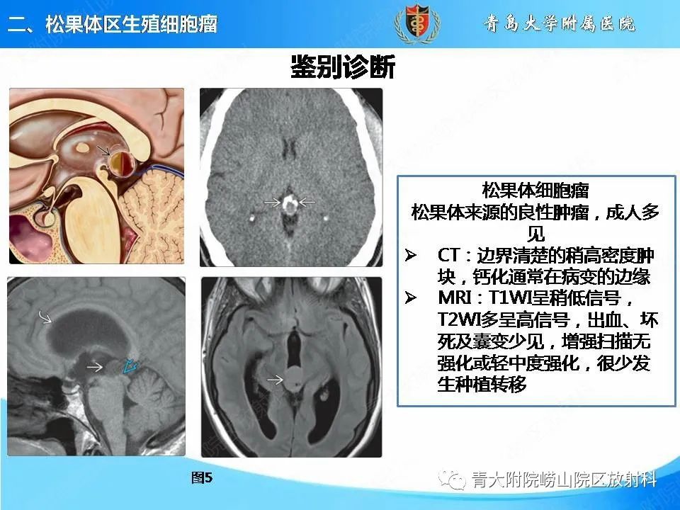 影像PPT - 【PPT】颅内生殖细胞瘤的影像学诊断-13