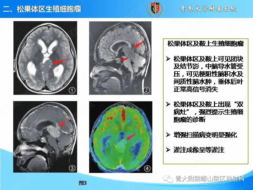 影像PPT - 【PPT】颅内生殖细胞瘤的影像学诊断-11