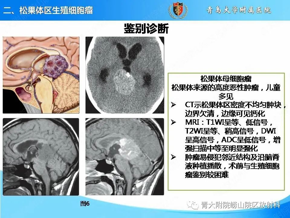 影像PPT - 【PPT】颅内生殖细胞瘤的影像学诊断-14