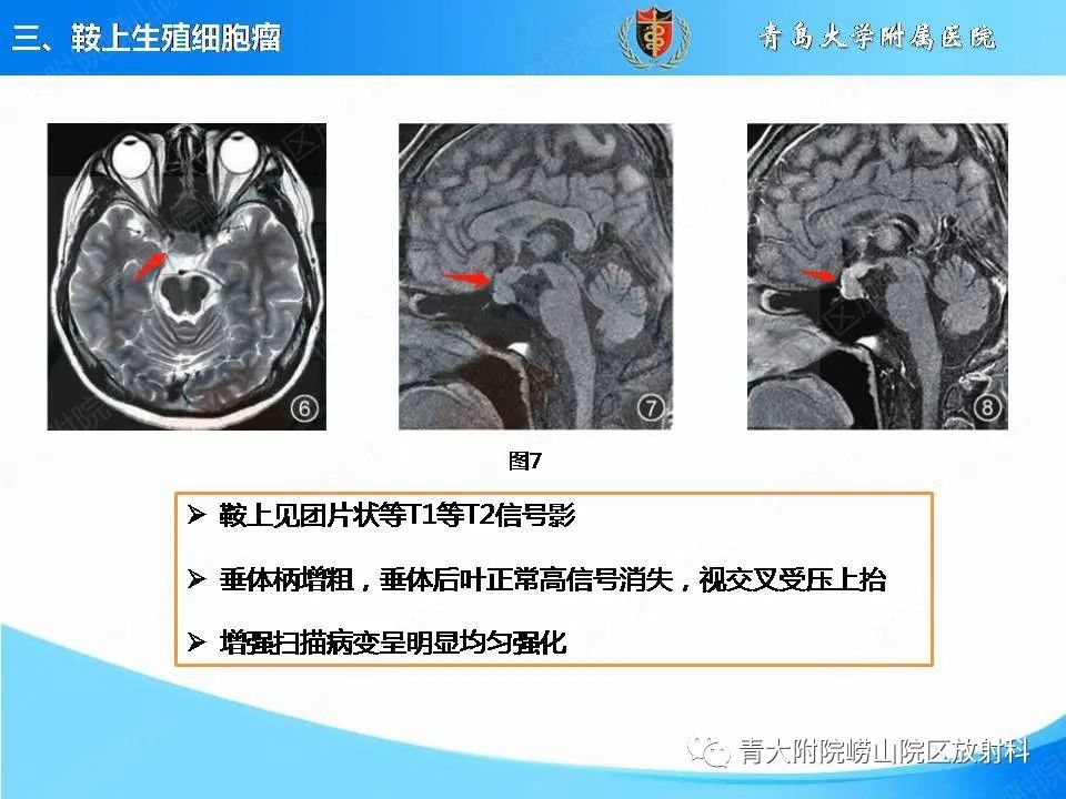 影像PPT - 【PPT】颅内生殖细胞瘤的影像学诊断-17