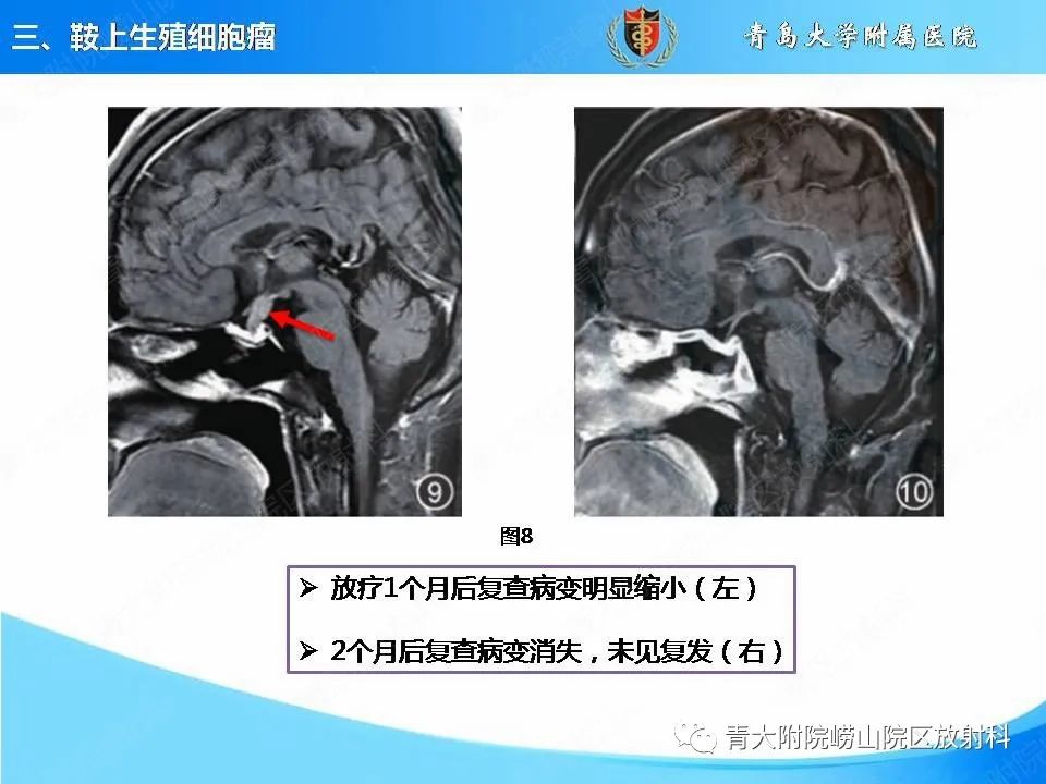 影像PPT - 【PPT】颅内生殖细胞瘤的影像学诊断-18