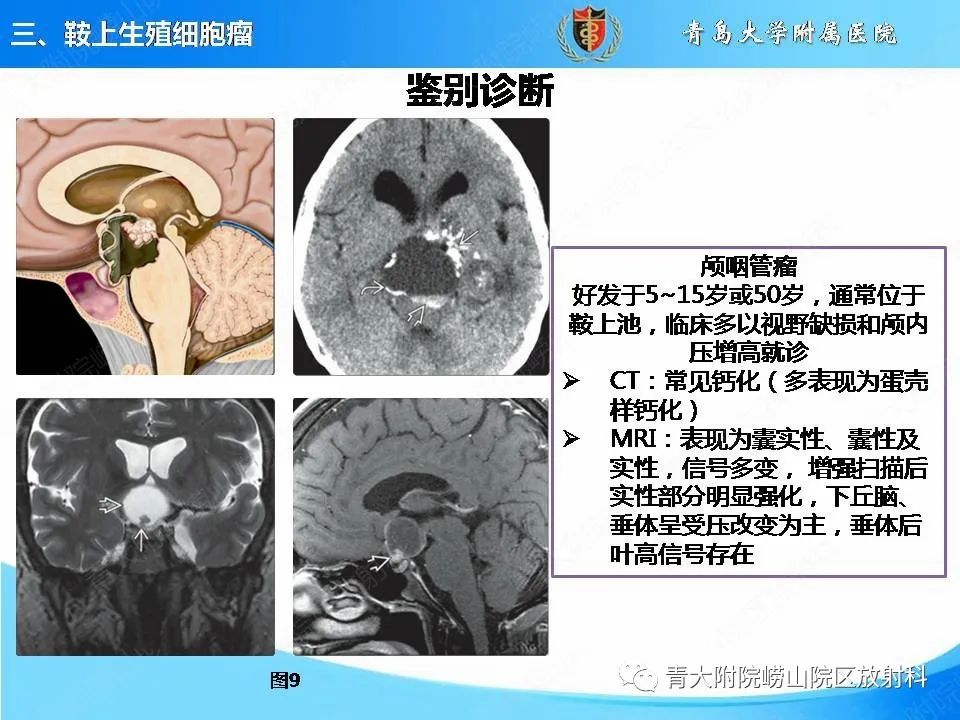 影像PPT - 【PPT】颅内生殖细胞瘤的影像学诊断-19