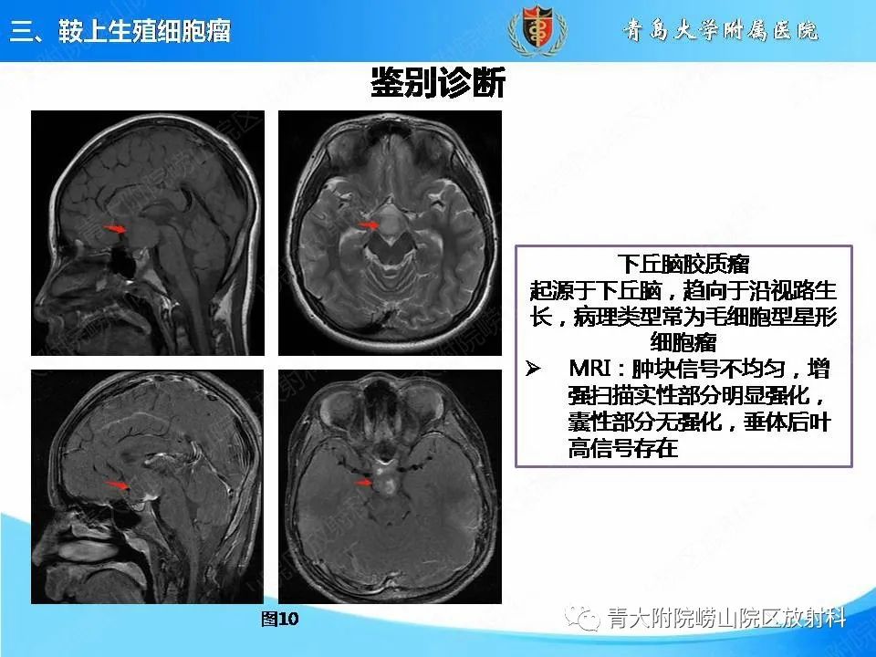 影像PPT - 【PPT】颅内生殖细胞瘤的影像学诊断-20