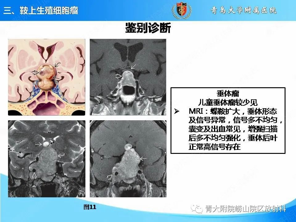 影像PPT - 【PPT】颅内生殖细胞瘤的影像学诊断-21