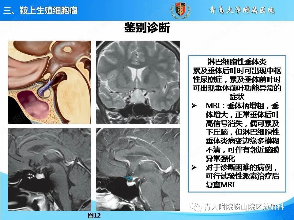 影像PPT - 【PPT】颅内生殖细胞瘤的影像学诊断-22