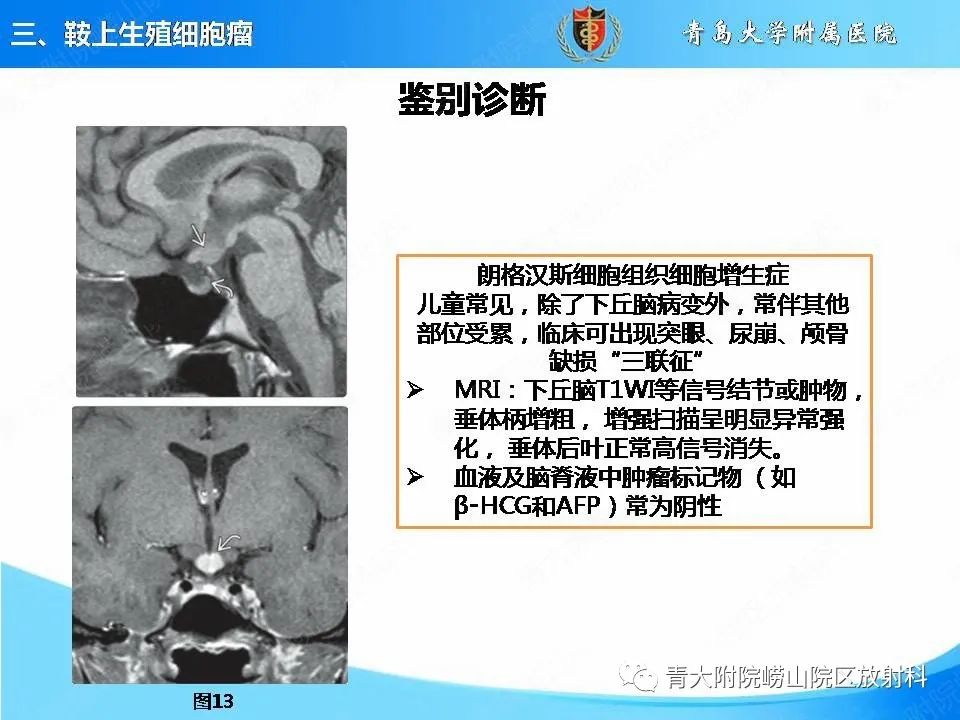 影像PPT - 【PPT】颅内生殖细胞瘤的影像学诊断-23