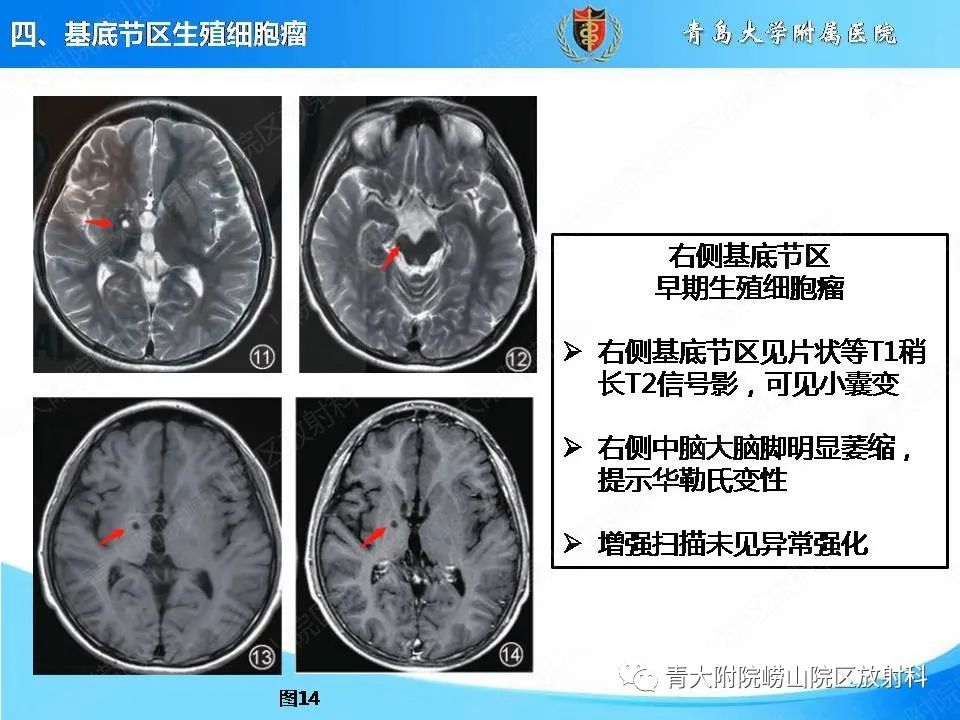 影像PPT - 【PPT】颅内生殖细胞瘤的影像学诊断-25