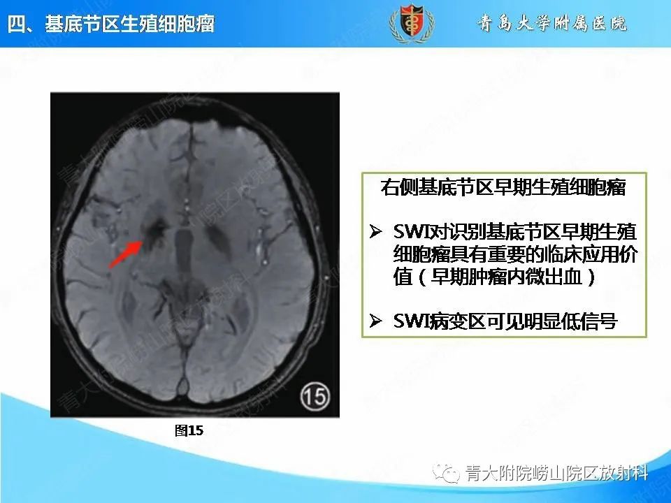 影像PPT - 【PPT】颅内生殖细胞瘤的影像学诊断-26