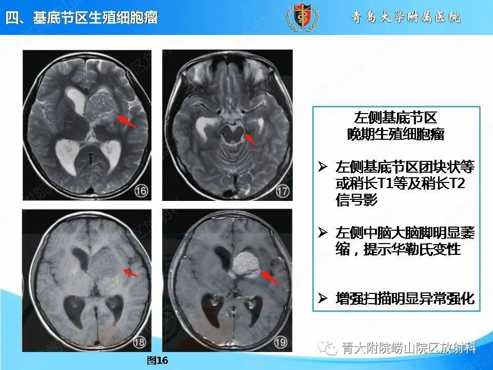 影像PPT - 【PPT】颅内生殖细胞瘤的影像学诊断-27