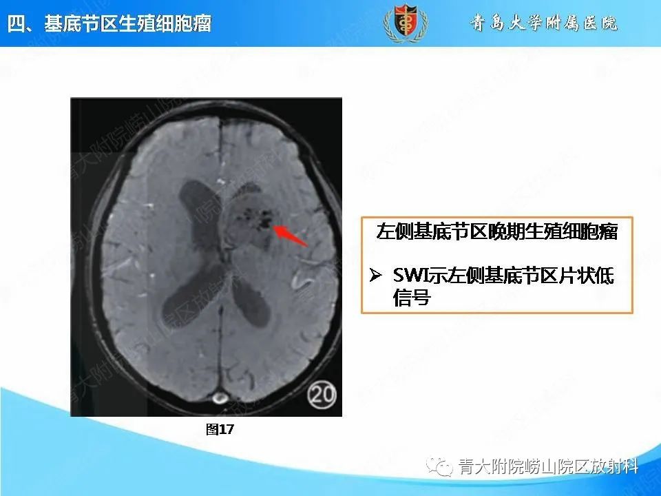 影像PPT - 【PPT】颅内生殖细胞瘤的影像学诊断-28