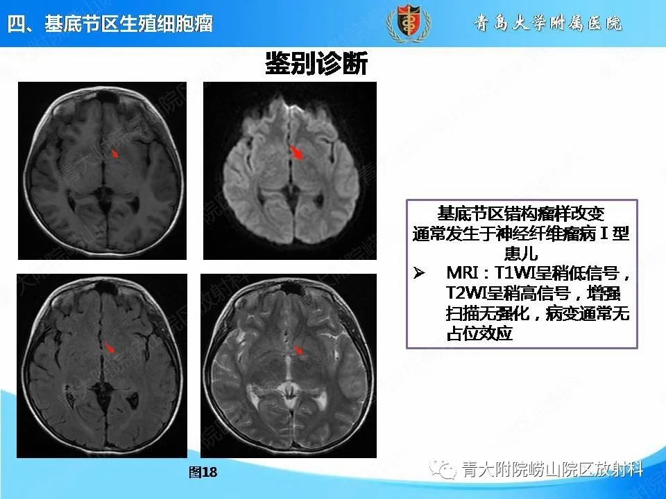 影像PPT - 【PPT】颅内生殖细胞瘤的影像学诊断-29