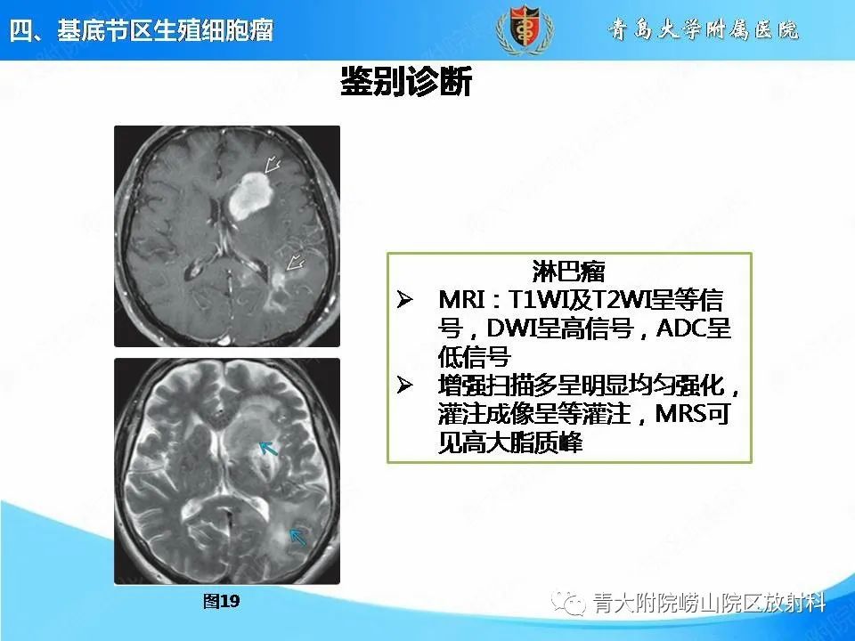 影像PPT - 【PPT】颅内生殖细胞瘤的影像学诊断-30