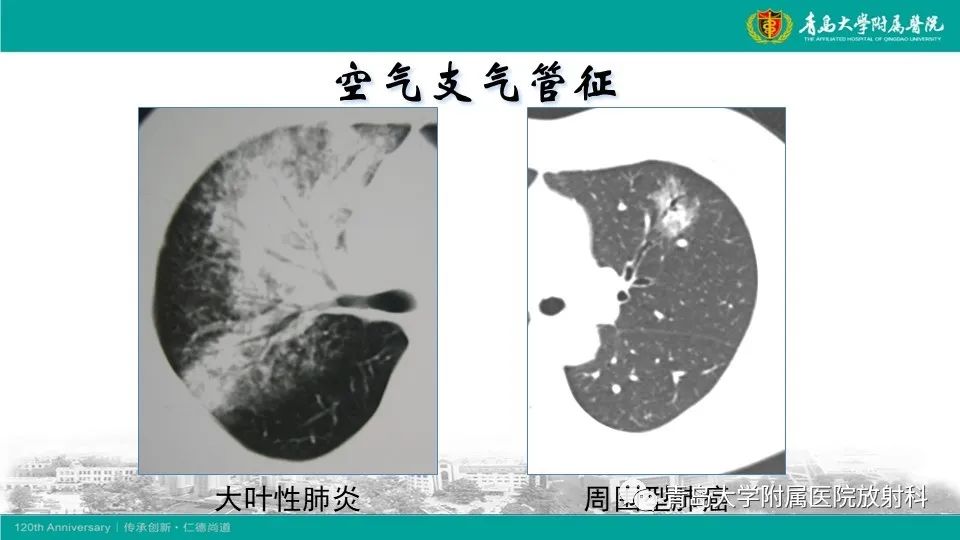 影像PPT - 【病例】大叶性肺炎1例CT影像-6