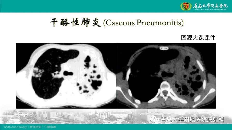 影像PPT - 【病例】大叶性肺炎1例CT影像-17