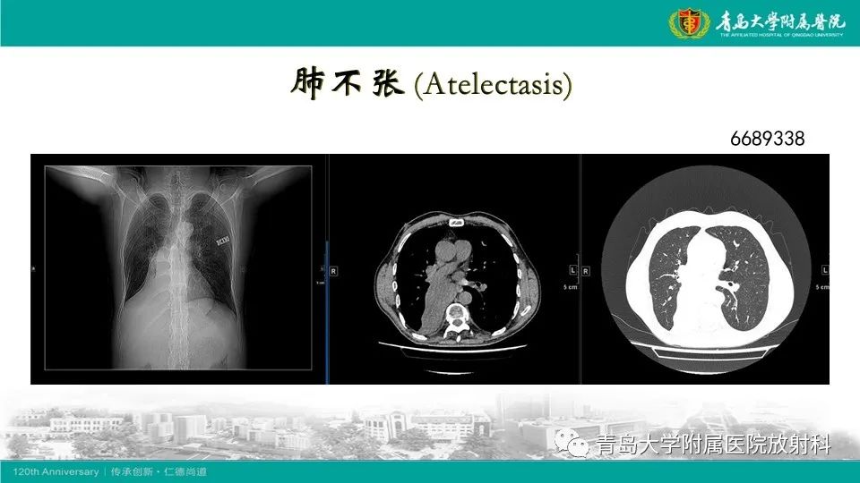 影像PPT - 【病例】大叶性肺炎1例CT影像-19