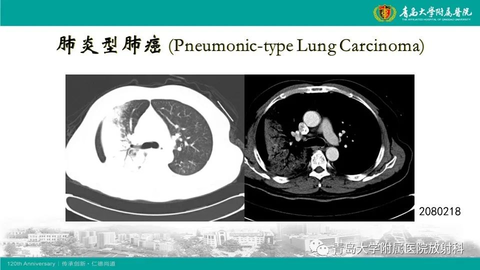 影像PPT - 【病例】大叶性肺炎1例CT影像-21