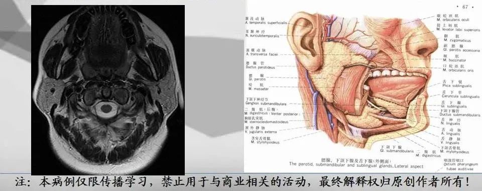 影像PPT - 【PPT】腮腺解剖-2 影像PPT - 【PPT】腮腺解剖-2