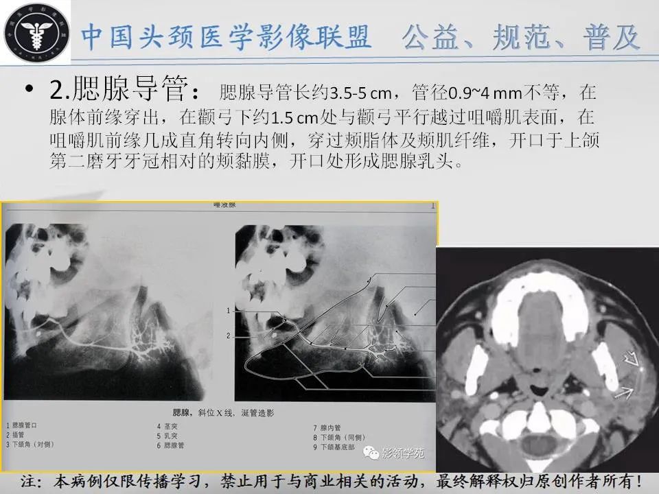 影像PPT - 【PPT】腮腺解剖-5 影像PPT - 【PPT】腮腺解剖-5