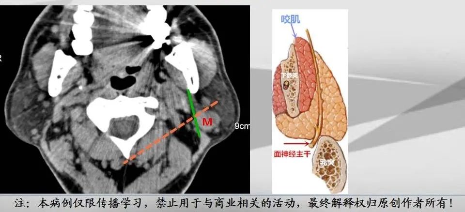 影像PPT - 【PPT】腮腺解剖-3 影像PPT - 【PPT】腮腺解剖-3