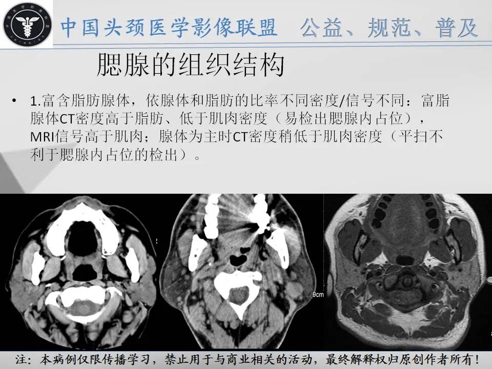 影像PPT - 【PPT】腮腺解剖-4 影像PPT - 【PPT】腮腺解剖-4