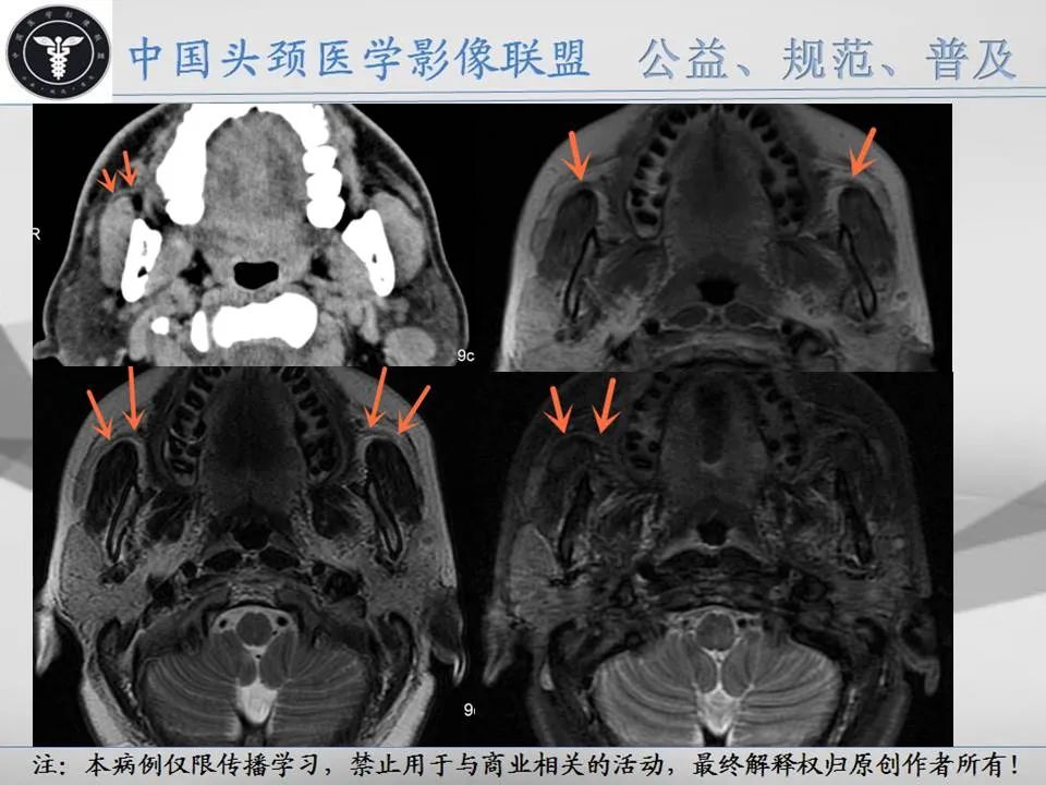 影像PPT - 【PPT】腮腺解剖-6 影像PPT - 【PPT】腮腺解剖-6