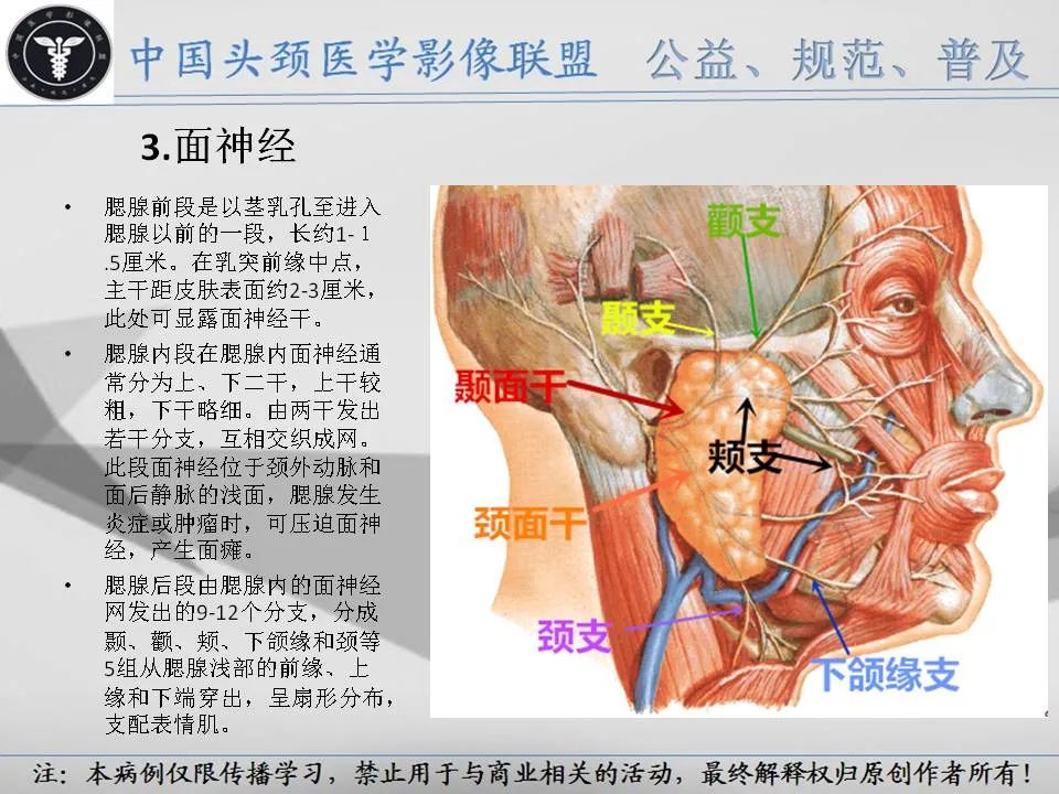 影像PPT - 【PPT】腮腺解剖-7 影像PPT - 【PPT】腮腺解剖-7