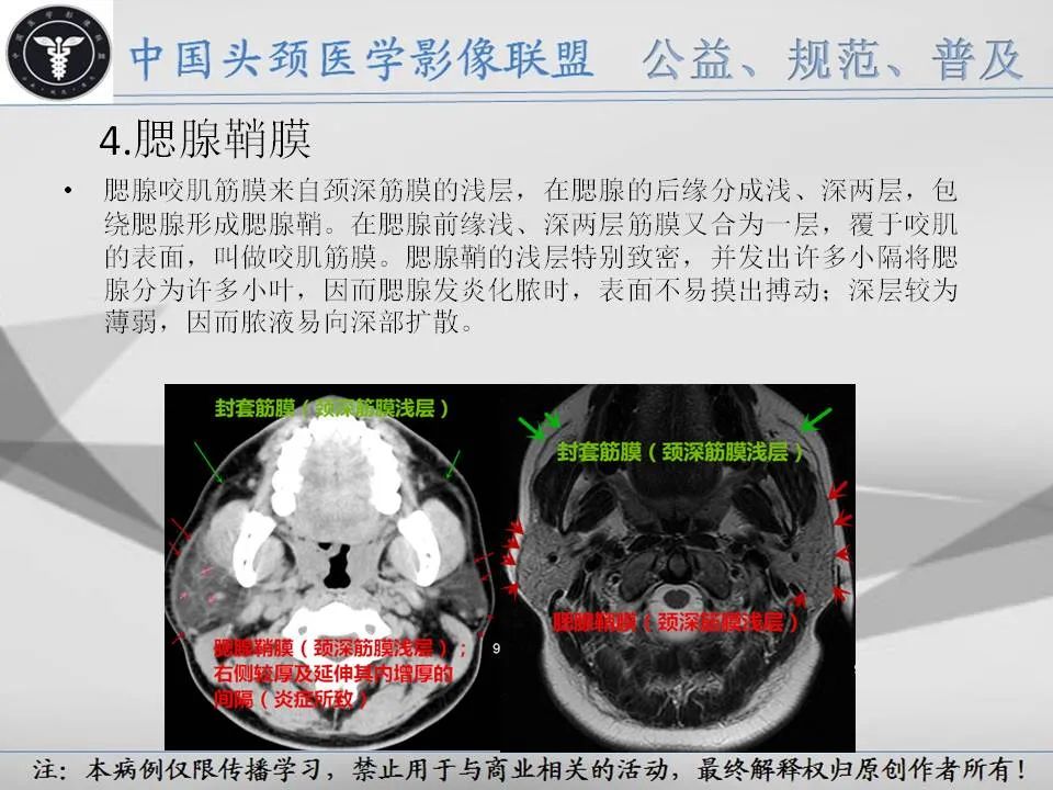 影像PPT - 【PPT】腮腺解剖-8 影像PPT - 【PPT】腮腺解剖-8