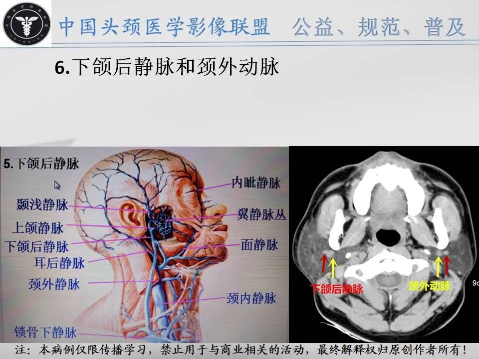 影像PPT - 【PPT】腮腺解剖-10 影像PPT - 【PPT】腮腺解剖-10