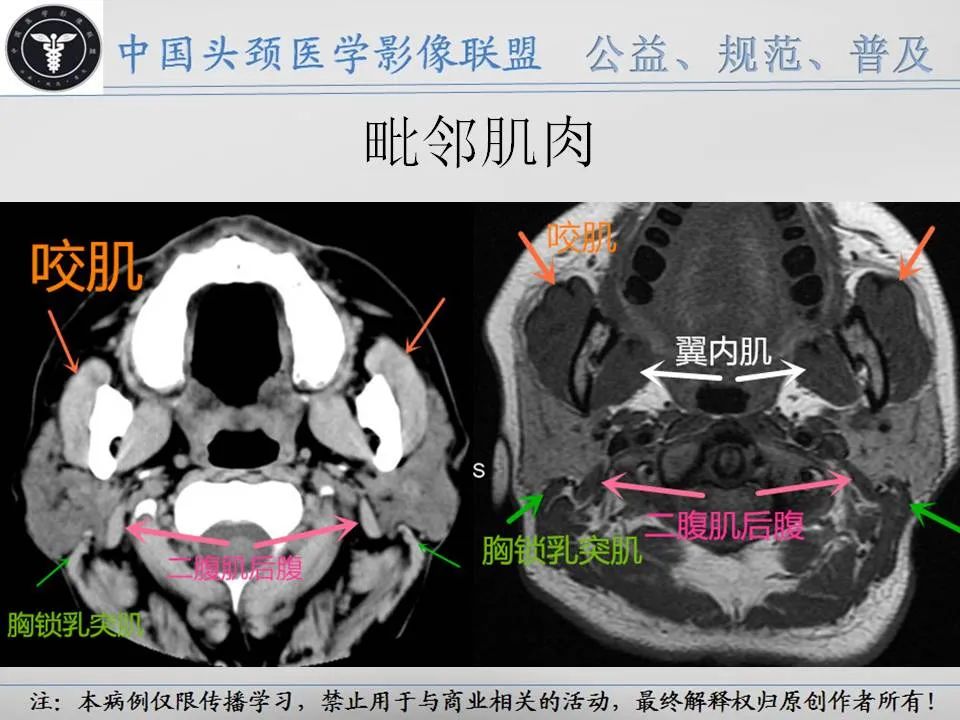 影像PPT - 【PPT】腮腺解剖-14 影像PPT - 【PPT】腮腺解剖-14