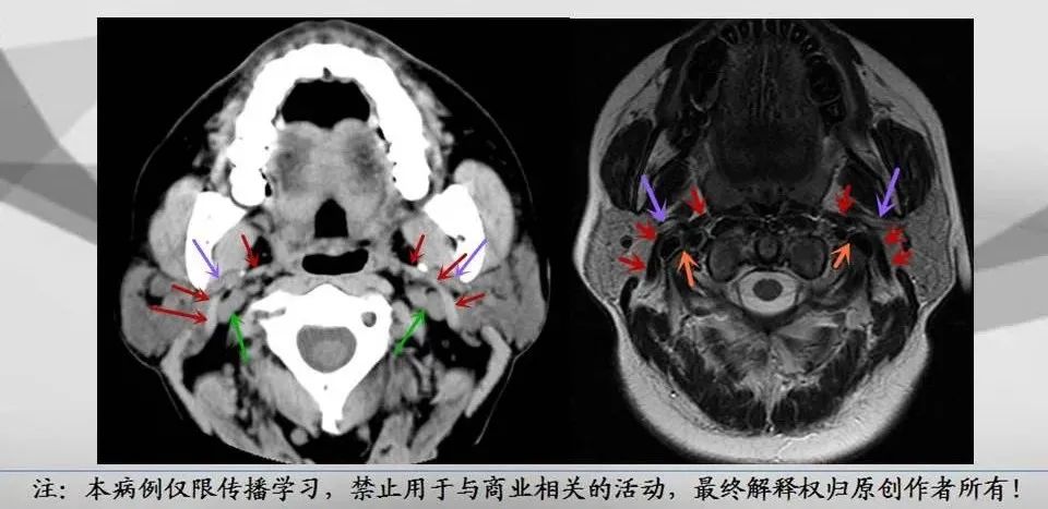 影像PPT - 【PPT】腮腺解剖-15 影像PPT - 【PPT】腮腺解剖-15