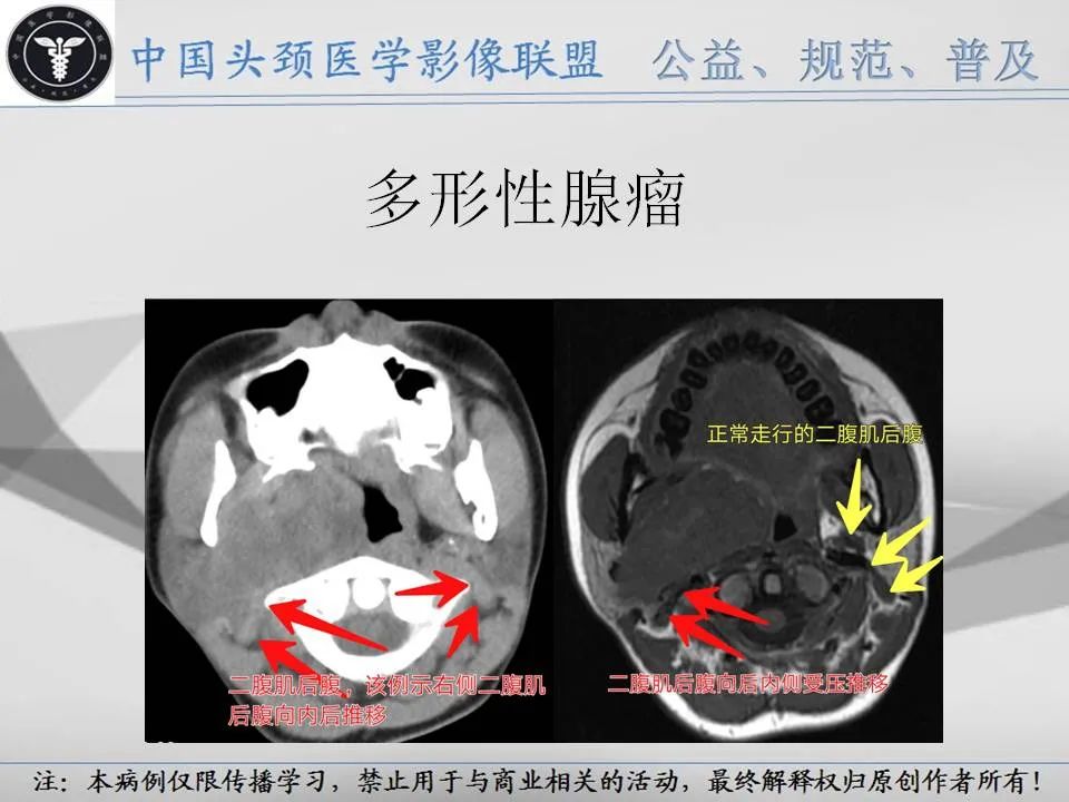 影像PPT - 【PPT】腮腺解剖-16 影像PPT - 【PPT】腮腺解剖-16