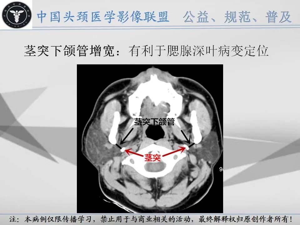 影像PPT - 【PPT】腮腺解剖-18 影像PPT - 【PPT】腮腺解剖-18
