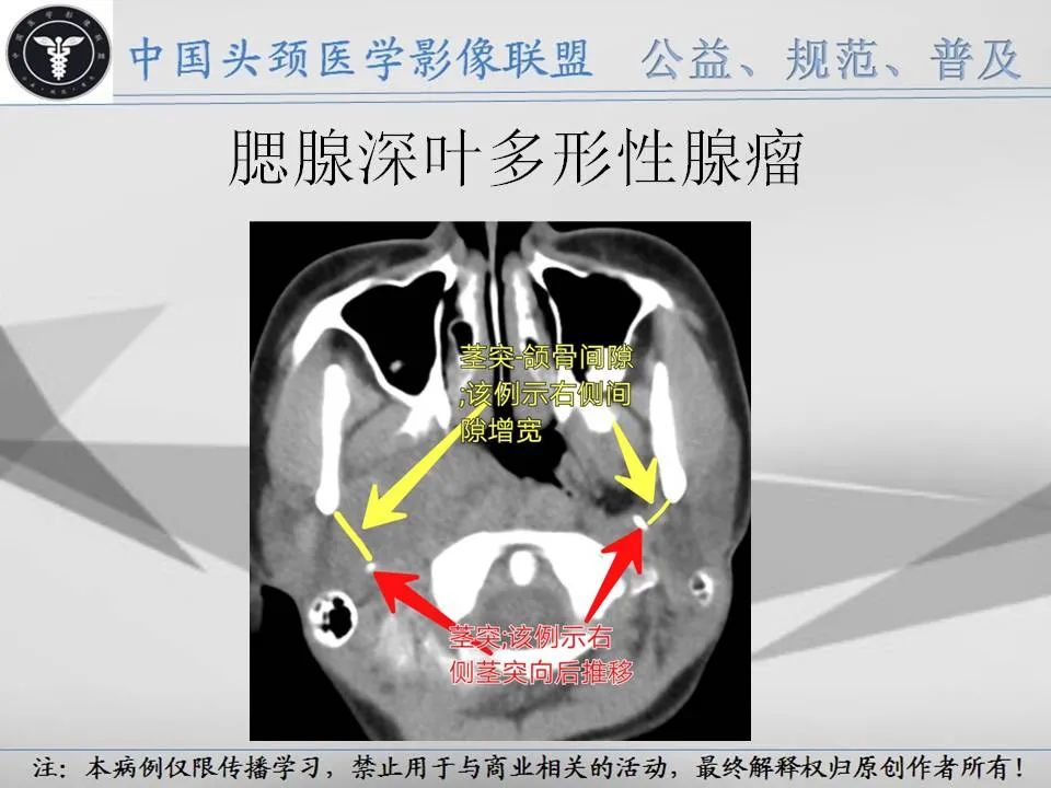 影像PPT - 【PPT】腮腺解剖-19 影像PPT - 【PPT】腮腺解剖-19