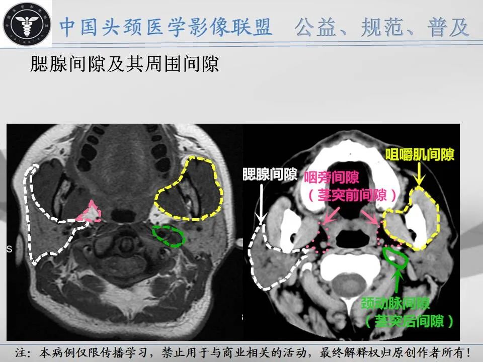 影像PPT - 【PPT】腮腺解剖-20 影像PPT - 【PPT】腮腺解剖-20