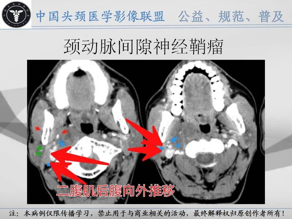 影像PPT - 【PPT】腮腺解剖-17 影像PPT - 【PPT】腮腺解剖-17