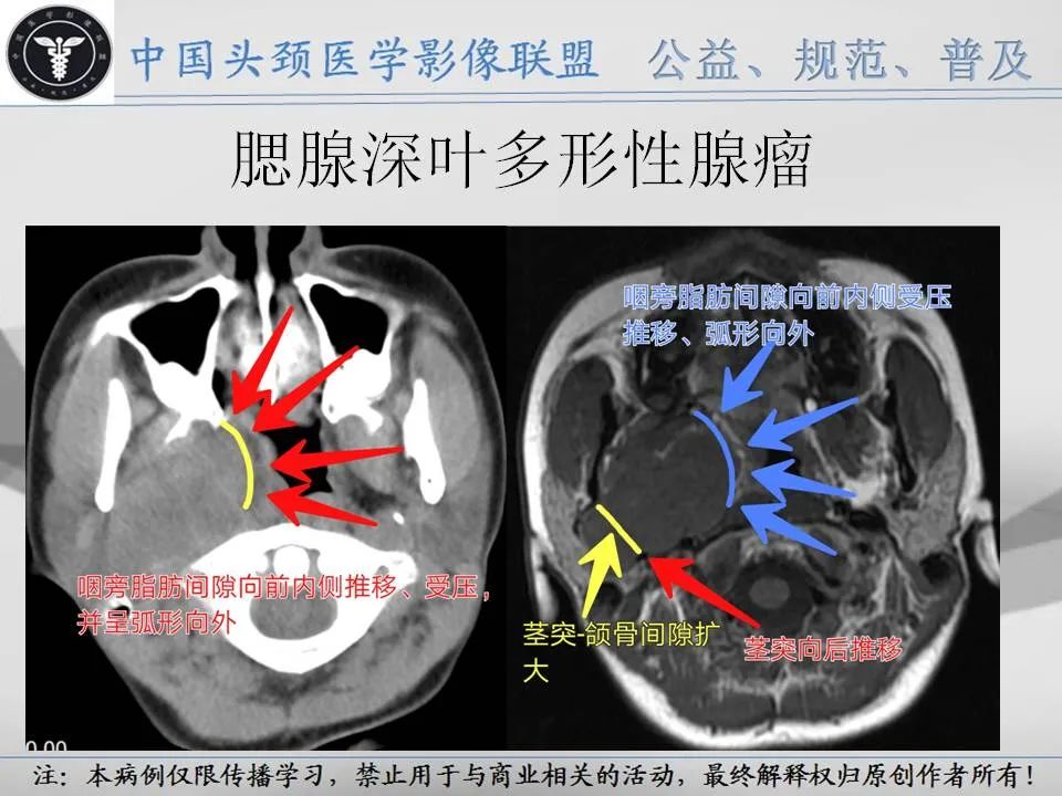 影像PPT - 【PPT】腮腺解剖-21 影像PPT - 【PPT】腮腺解剖-21