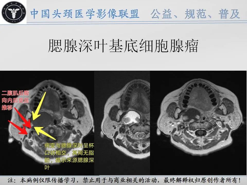 影像PPT - 【PPT】腮腺解剖-22 影像PPT - 【PPT】腮腺解剖-22