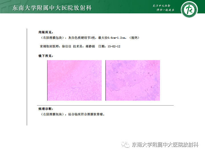 影像PPT - 【PPT】滑膜软骨瘤病-4 影像PPT - 【PPT】滑膜软骨瘤病-4